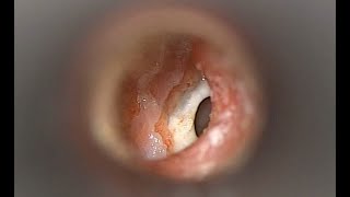 Otomycosis Ear Dusting with Antifungal Powder [upl. by Suoivatra]