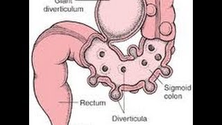 Top 3 Ways To Prevent Diverticulitis Attacks [upl. by Prescott182]