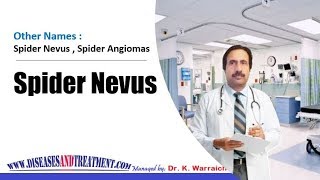 Spider Nevus Spider Angiomas  Causes Diagnosis Symptoms Treatment Prognosis [upl. by Mohl173]