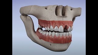 Acrylic Partial Denture Flipper [upl. by Adehsar546]