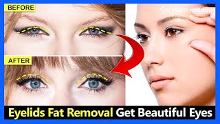 Eyelids Fat Removal Exercises  Get Bigger Eyes Beautiful Double Eyelids Fix Droopy Eyelids [upl. by Ettenauq761]