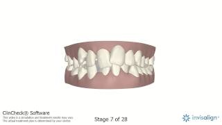 MiSmile Network  ClinCheck Example for a Complex Case [upl. by Eleon666]