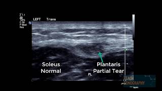 Normal and abnormal plantaris tendon of the calf [upl. by Kcyrred]