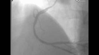 angioplastia en Infarto Agudo [upl. by Xet]