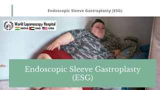 Endoscopic Sleeve Gastroplasty ESG animation of procedure performed with the Apollo ESG™ [upl. by Folsom]