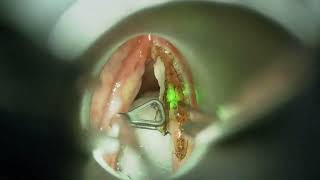 Type 1 Cordectomy By Using TrueBlue Laser [upl. by Ellinehc142]