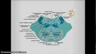 Medial Inferior Pontine Syndrome pics [upl. by Citron159]