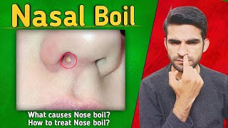 Nose Boil in urdu hindi  Nose boil causes symptoms treatment amp complications [upl. by Yelram50]