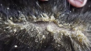 Dandruff scratching removal on head using black combing390 [upl. by Volney]