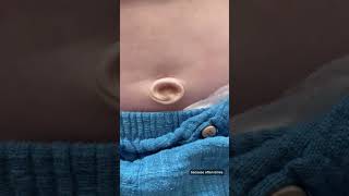 Umbilical hernia in babies baby educational postpartum newborn [upl. by Voltz]