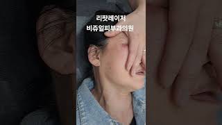 리팟 부작용 홍반 붉음증 리팟 레이저 비쥬얼피부과 세종리팟 세종시리팟 reepot lentigo 청주리팟 공주리팟 대전리팟 오창리팟 오송리팟 부여리팟 [upl. by Drofla]