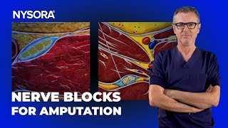 Sciatic  Femoral Nerve Blocks for AKA Amputation [upl. by Mercorr]