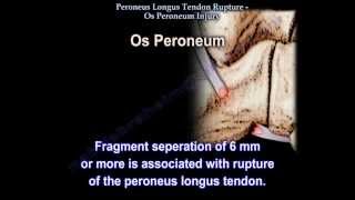 Peroneus Longus Tendon Rupture Os Peroneum Injury  Everything You Need To Know  Dr Nabil Ebraheim [upl. by Sidoney]