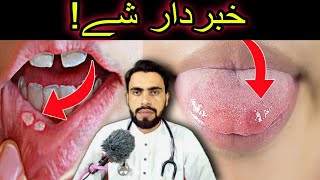 Mouth Ulcers or Canker Sore and Mouth Cancer Awareness in Pashto by Dr Mustaqeem [upl. by Irual403]