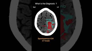 Spontaneous ICH  CT brain Acute CT Brain Intracerebral haemorrhageICH 69 radiologychannel007 [upl. by Alyakcm]