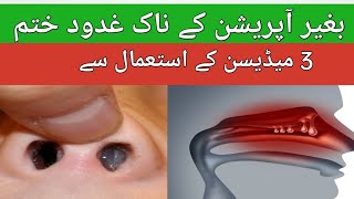 Nasal polyp treatment without surgerynaak ki polyp ka ilaj [upl. by Dnob]