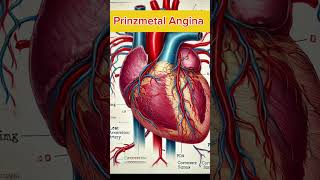 quotPrinzmetal Angina Explained Causes Symptoms and Treatmentquot [upl. by Dahl633]