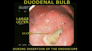 LARGE DUODENAL BULB ULCER  Endoscopic appearance [upl. by Akinimod]