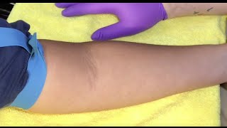 Tips For Locating Difficult Veins [upl. by Nesyla]