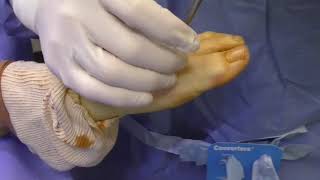 Bunion Screw Removal [upl. by Harriman]