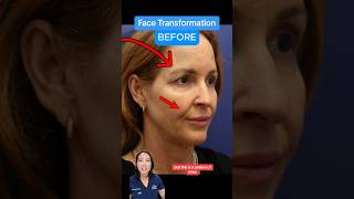 FULL Facelift Transformation BEFORE AFTER [upl. by Warga]