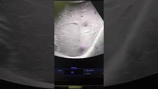 Early Liver Abscess [upl. by Aehs]