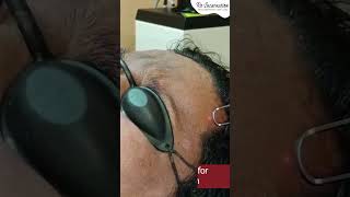 QSwitch Laser Treatment for Pigmentation  Dr Priyanka Aggarwal  Dermatologist [upl. by Norwood]