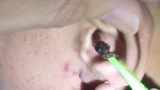 Mans Dark Giant Earwax Removal [upl. by Treblah]