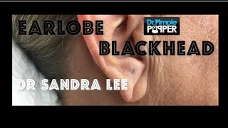 A nice earlobe blackhead extracted [upl. by Clark]