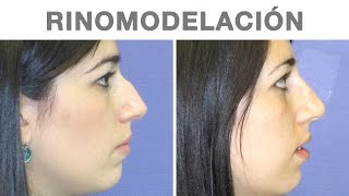 Rinomodelación  Rinoplastia Sin Cirugía  Testimonio de María José [upl. by Vivl286]