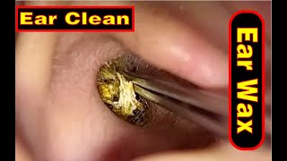 Ear wax removal amp Ear Cleaning （9） [upl. by Pippy]