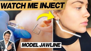 Jaw Filler Before amp After With Procedure  Technique Needle [upl. by Steere692]