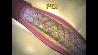 Trial of Everolimus Eluting Stents or Bypass Surgery for Coronary Disease [upl. by Higbee]