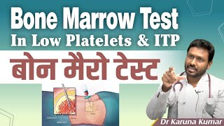 Bonemarrow Test in Low Platelets and ITP  Diagnosis of ITP  Dr Karuna Kumar  Hematologist [upl. by Ennaj931]