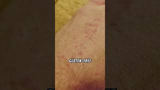 Dermatitis Herpetiformis Relief [upl. by Recnal404]