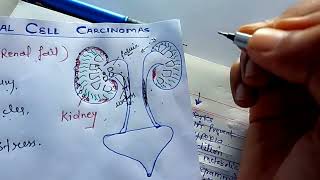 renal carcinoma pathology NGMedicals [upl. by Ennywg885]