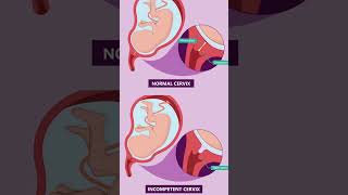 Short cervix during pregnancy 🫄Understanding Cervical Insufficiency pregnant September 8 2024 [upl. by Milissa]