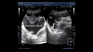 Hemoperitoneum with intestinal obstruction [upl. by Illib]