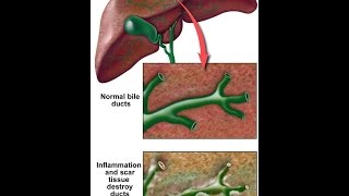 Primary Sclerosing Cholangitis [upl. by Yllek]