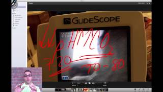 Glidescope intubation and annotation [upl. by Bull]