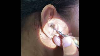 Removing Womans Giant Earwax Using An Ear Curette [upl. by Ardua]