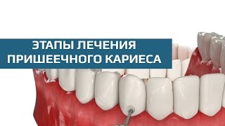 Лечение пришеечного кариеса этапы лечения пришеечного кариеса [upl. by Vaughan688]