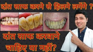 Do Teeth cleaning makes teeth loose Dental Cleaning  Myths and Facts in hindi Dr Pranay Thakkar [upl. by Noak]