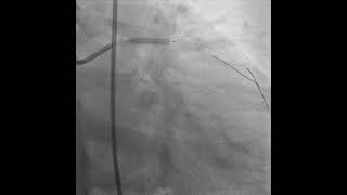 PROVISIONAL STENTING OF LAD  D1 BIFURCATION [upl. by Delphinia]