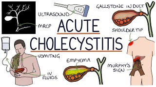 Understanding Acute Cholecystitis [upl. by Uyr]