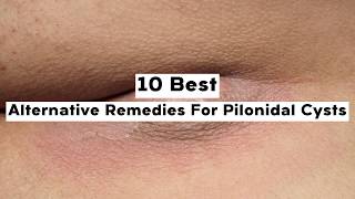 10 Alternative Remedies For Pilonidal Cysts [upl. by Lucina788]