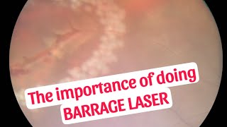 Importance of doing Barrage laser [upl. by Ut]