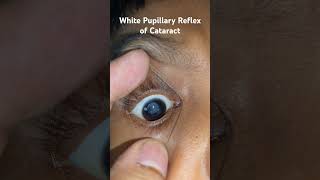 Leukocoria  White Pupillary Reflex of cataract [upl. by Annadal]