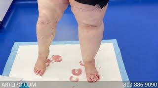 Cankles amp Knees Liposuction  Lipedema Legs  Expert Dr Thomas Su [upl. by Zephaniah]