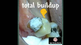 splint under cosmetic total buildup premolar tooth mobile amp deep caried enamel shell almost ruined [upl. by Amimej]